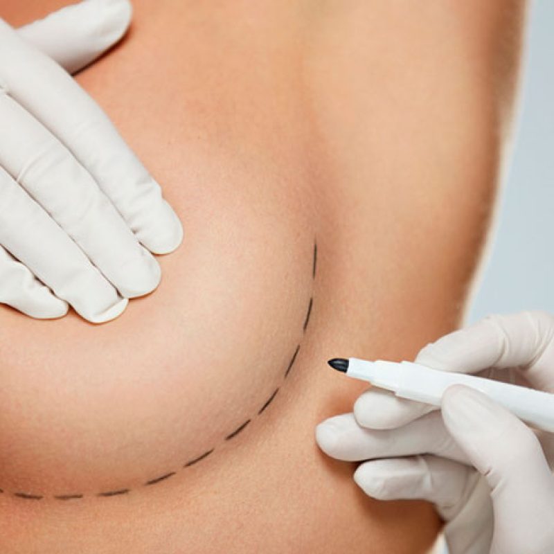mamoplastia